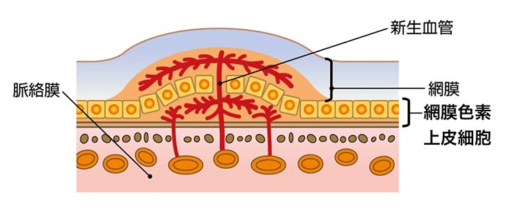 加齢黄斑変性画像