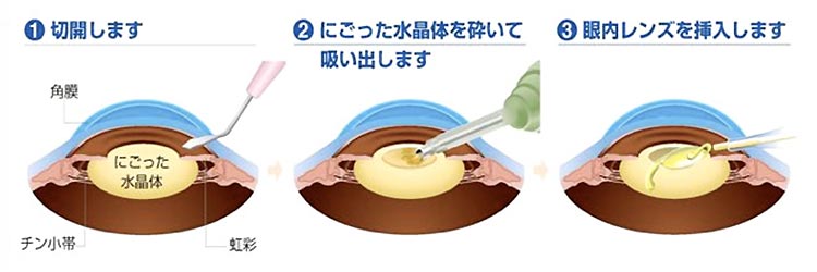 白内障手術の手順画像
