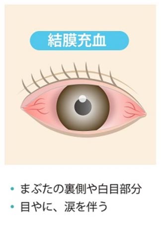 結膜炎画像