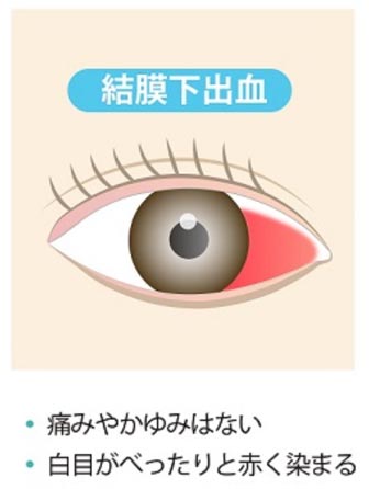 結膜下出血画像