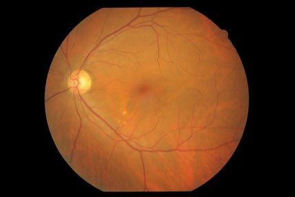 糖尿病網膜症画像