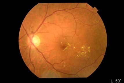 糖尿病網膜症画像