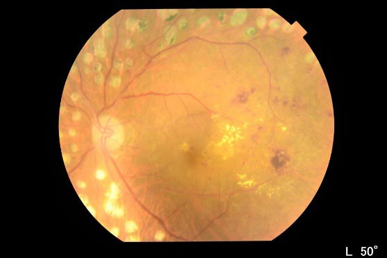 糖尿病網膜症画像
