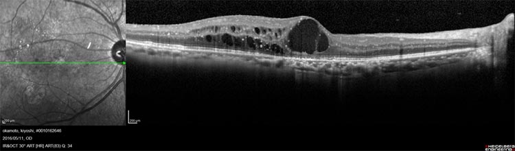 糖尿病網膜症画像