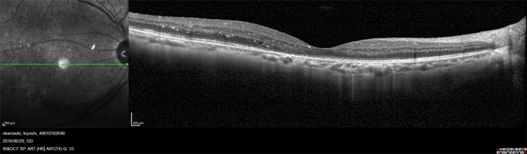 糖尿病網膜症画像
