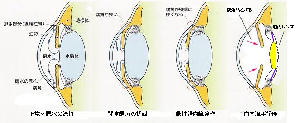 急性緑内障発作画像
